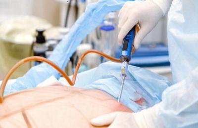 Liposuktion
